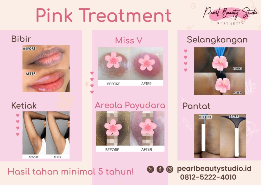 Pink Treatment Bekasi, Jakarta, Tangerang, Bekasi, Depok dan Bogor Murah